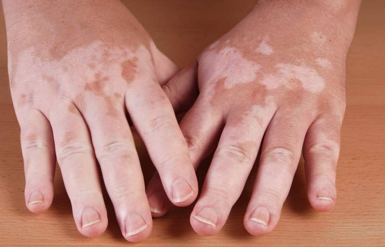 Día del Vitiligo y sus conexos 
